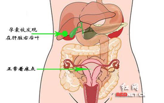 入院后hcg(人绒毛膜促性腺激素)明显升高,彩超检查没有在及盆腔