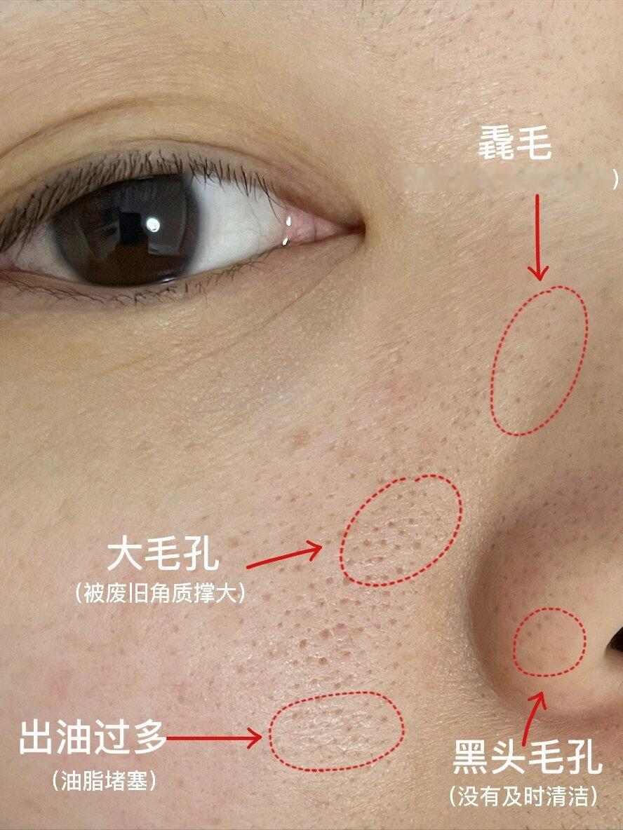 偶然发现的！脸上长这个的姐妹要小心了！​​​