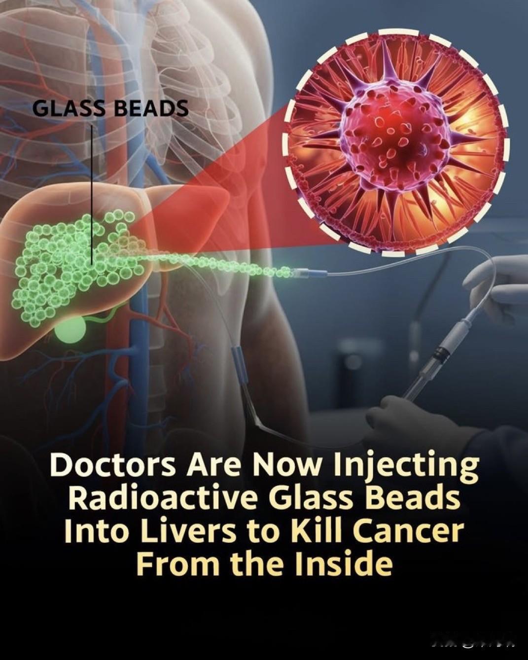 突发新闻：美国医生正在将微小的放射性颗粒注射到肿瘤中……这正在改变癌症治疗。
