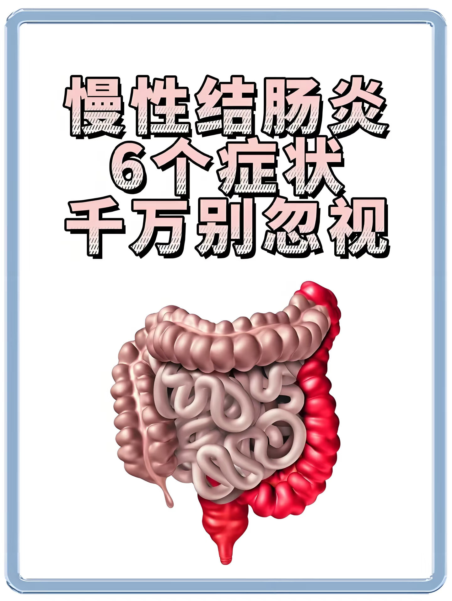 慢性结肠炎6个症状千万别忽视！