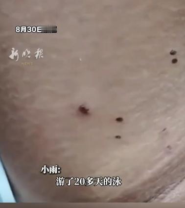 太吓人！天天游泳减肥，女孩身上疯狂冒出20多个疙瘩。最开始，只是胳膊腋下