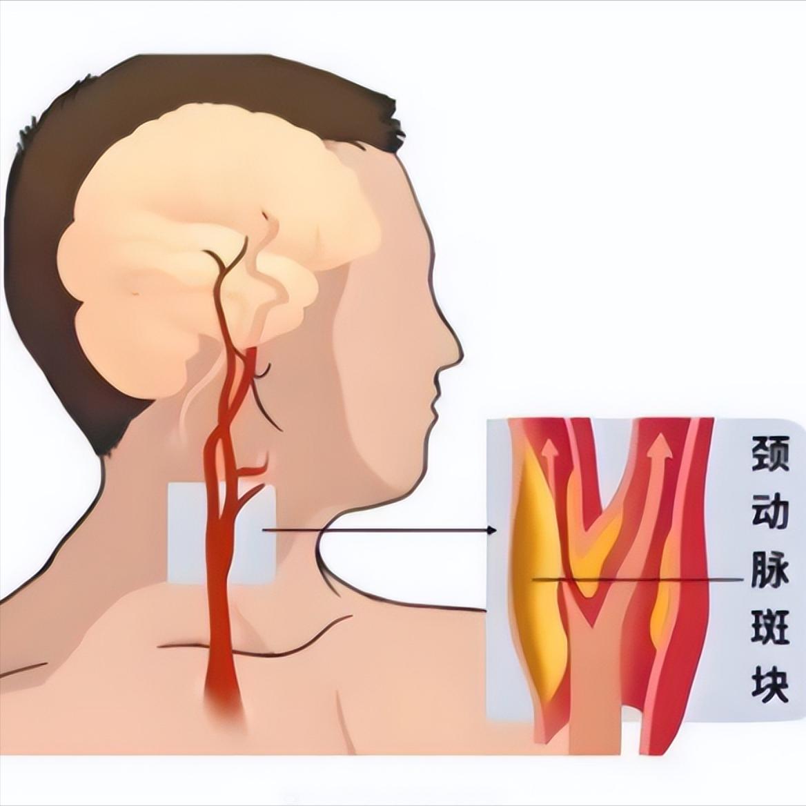 体检查不出血管斑块？看到“正常”报告以为没事，其实血管已经出问题了常规体检正