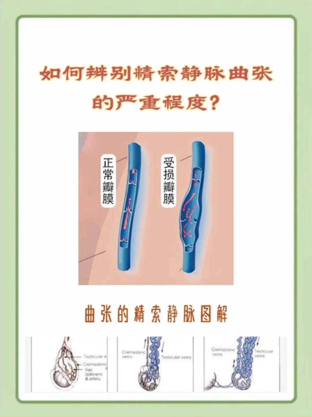 如何辨别精索静脉曲张的严重程度?