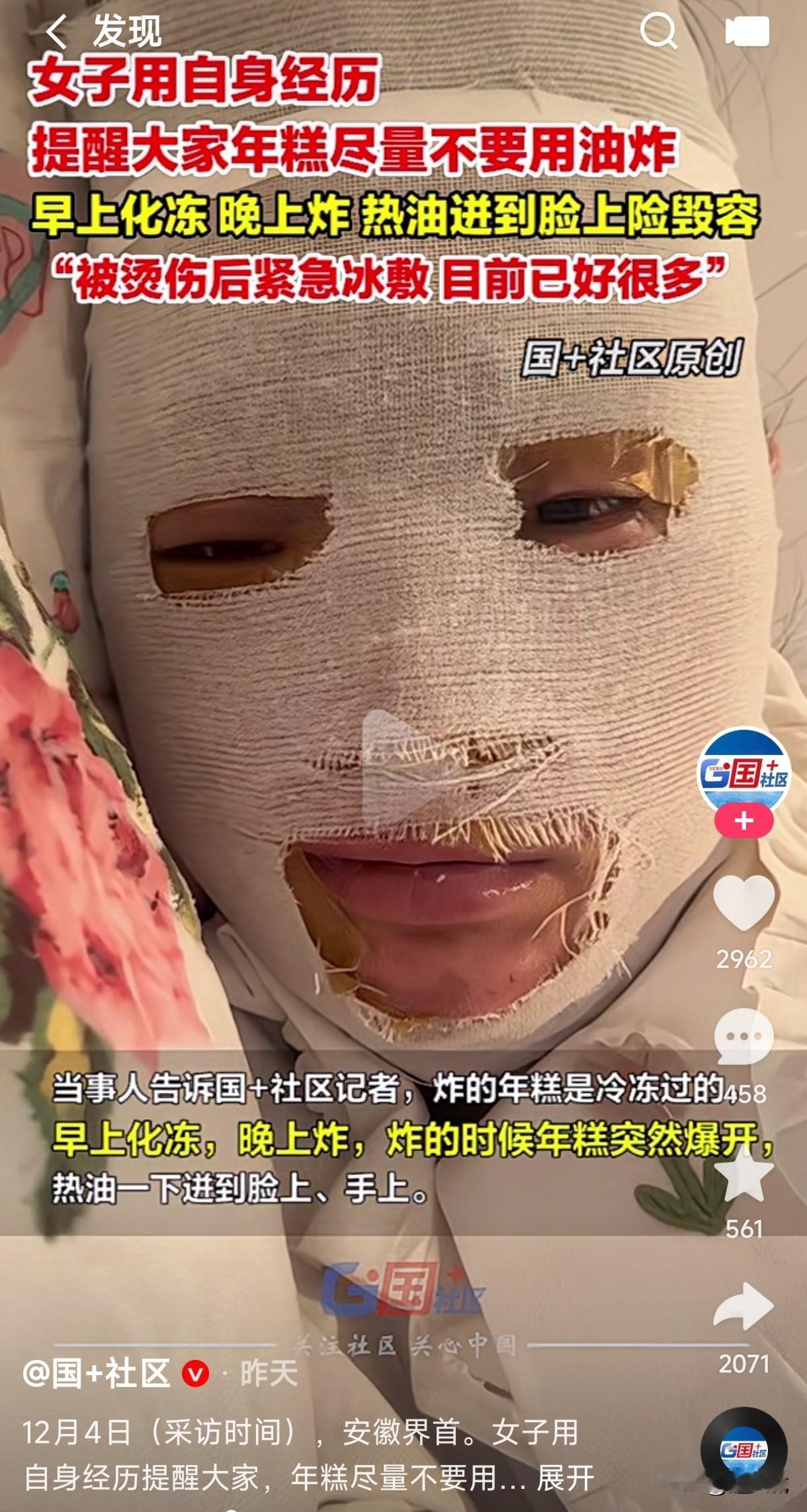 年糕不能用油炸吗？女子把年糕拿出化冻后，放进油锅用油炸时热油瞬间迸到脸上险遭毁