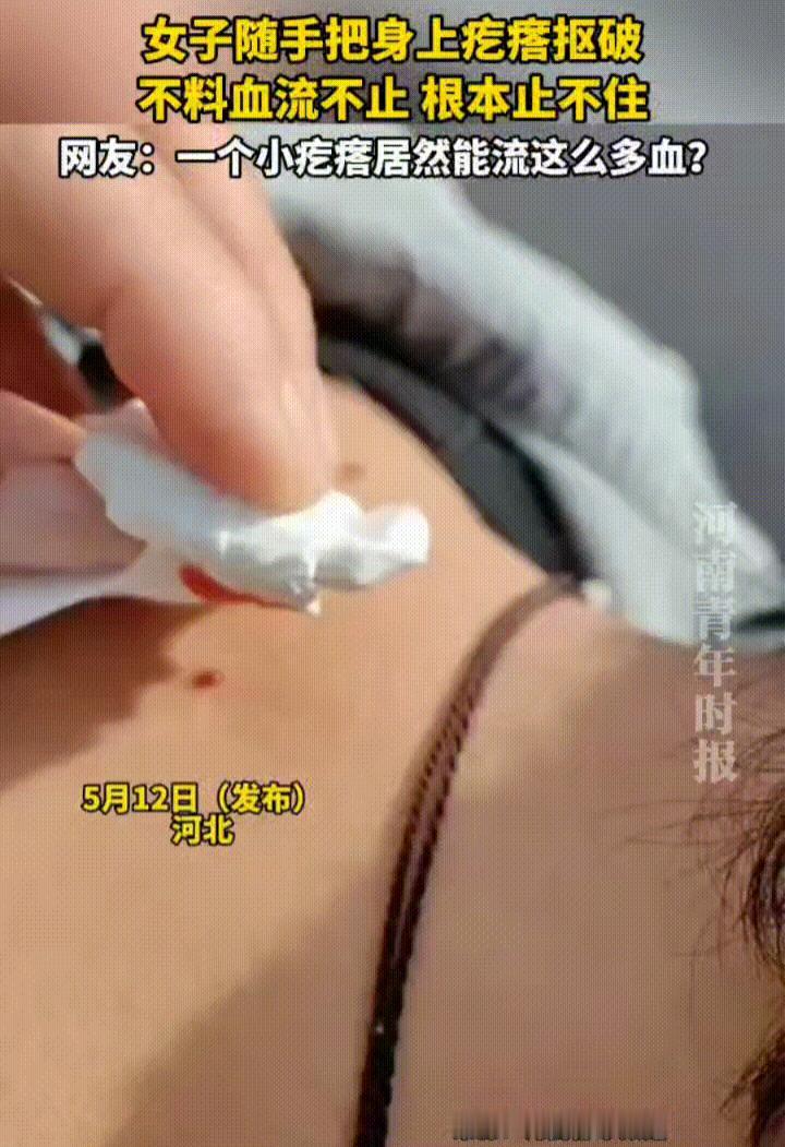 女子身上长了一颗不起眼的小疙瘩，她随手将其抠破，不料伤口竟然像开了闸的水龙头一样