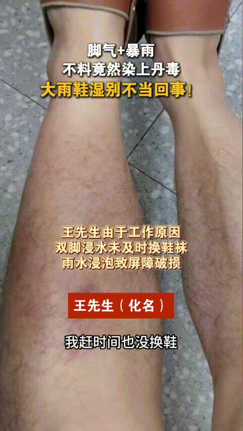 “太可怕了！”近日，一男子去广州出差时突遇暴雨，长期患有脚气的脚也不小心浸泡在了