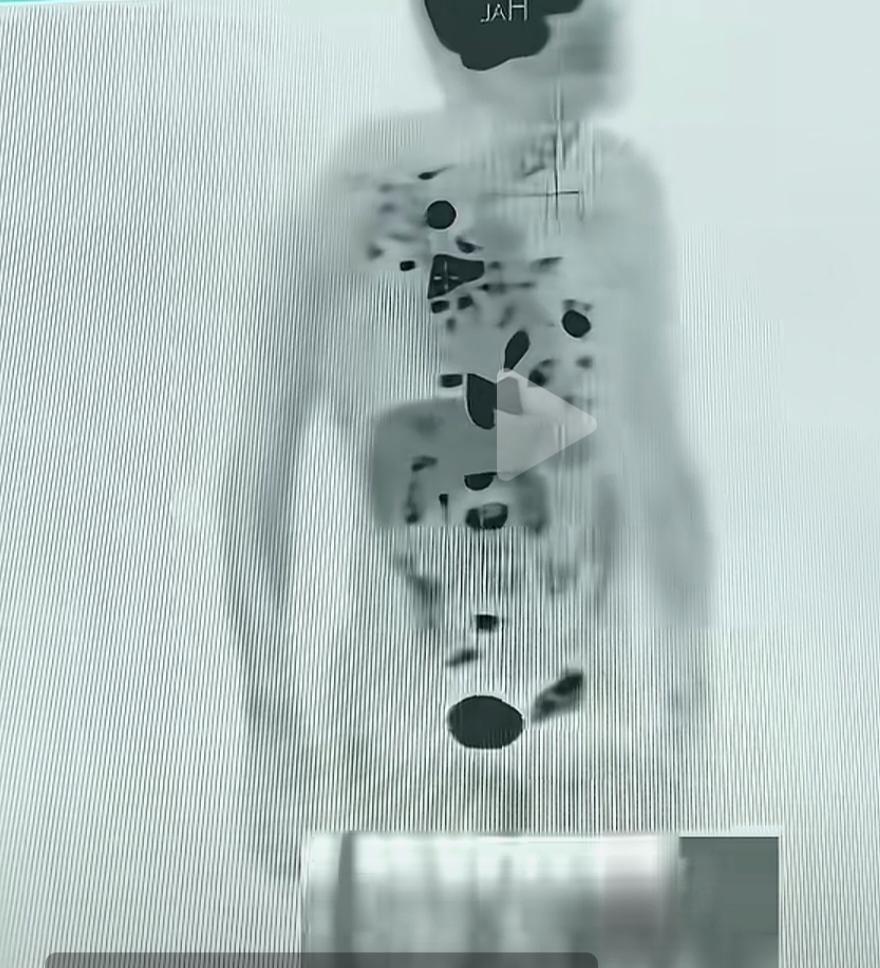 一下子看得我头皮都发麻了。83岁的老人第一次检查身体。结果是这样的，您看那些阴