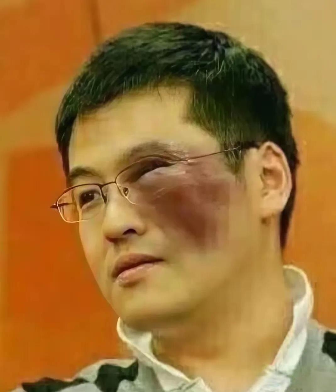 从网上看到这张图片，人物脸眼乌青，还肿得老高。这是啥造型呀。看完配文才知道，原来