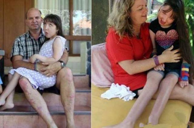 为了让女儿停止发育, 父母选择切除女儿子宫, 称这是对她的保护