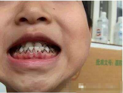 宝宝牙齿上的黑斑你以为仅是蛀牙吗?