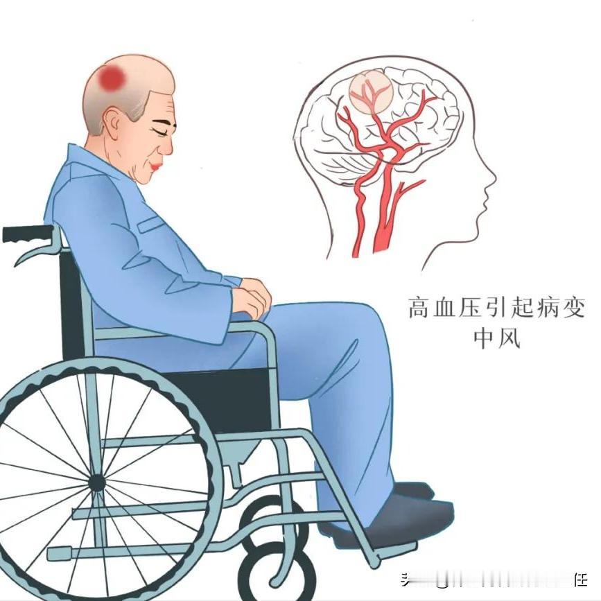 高血压不重视，可是为脑出血埋下了隐患！ 1.突发炸裂性疼痛后脑勺或全头部