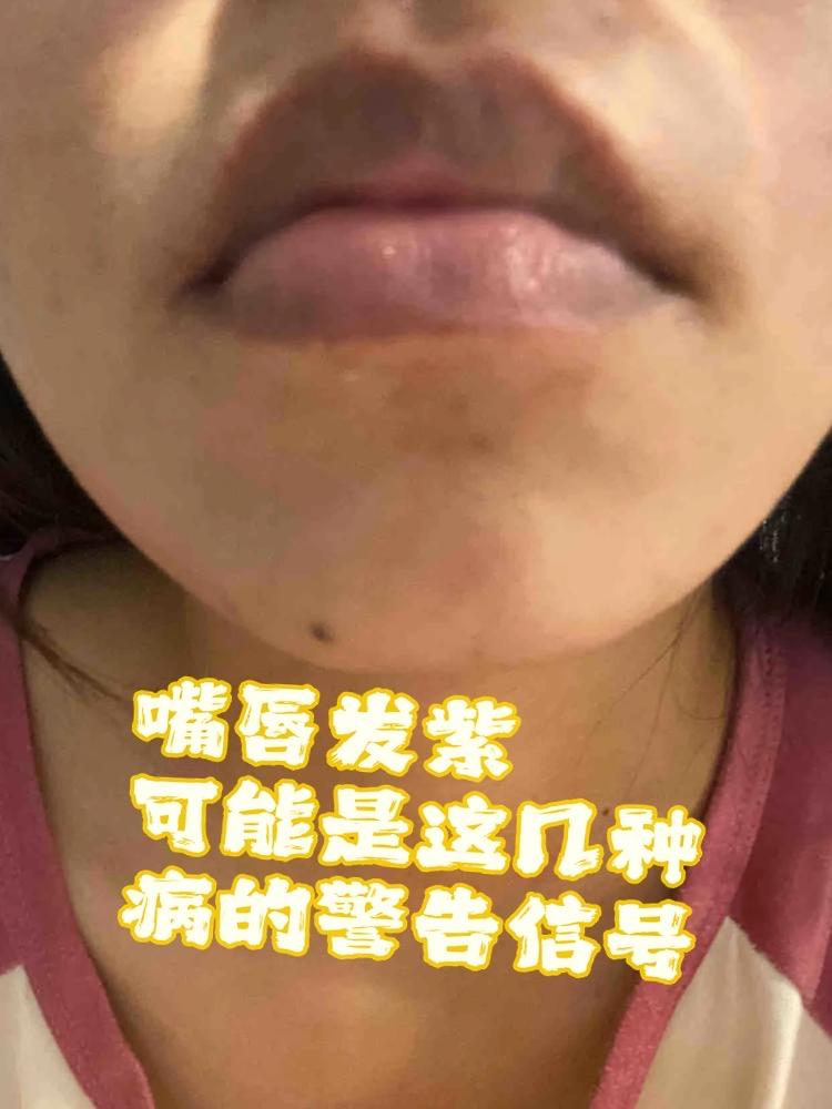 嘴唇发紫=心脏出问题？别慌！90%的人都被这个误区骗惨了你有没有过这样的经历