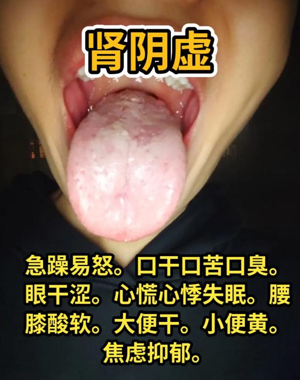 3种常见男性复合体质舌象，对照自查，精准辨证