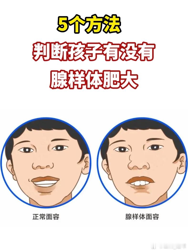 治療小儿腺樣體肥大中医是能治疗腺样体肥大的：因为饮食积滞、心肝火旺引起的肥大，治