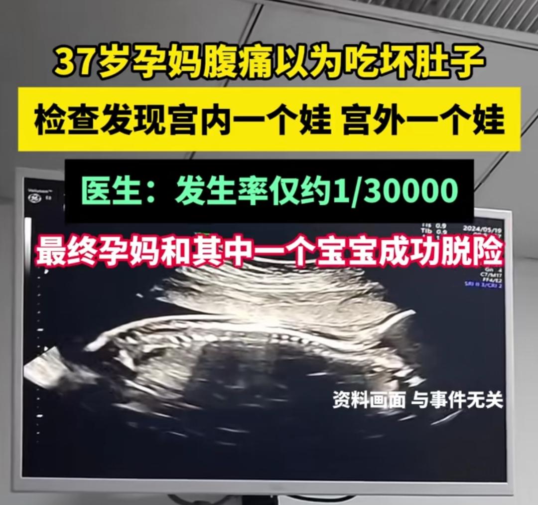 孕妇肚子疼，没想到去医院却不是吃坏肚子37岁的孕妈持续肚子疼，以为是肠胃炎，没