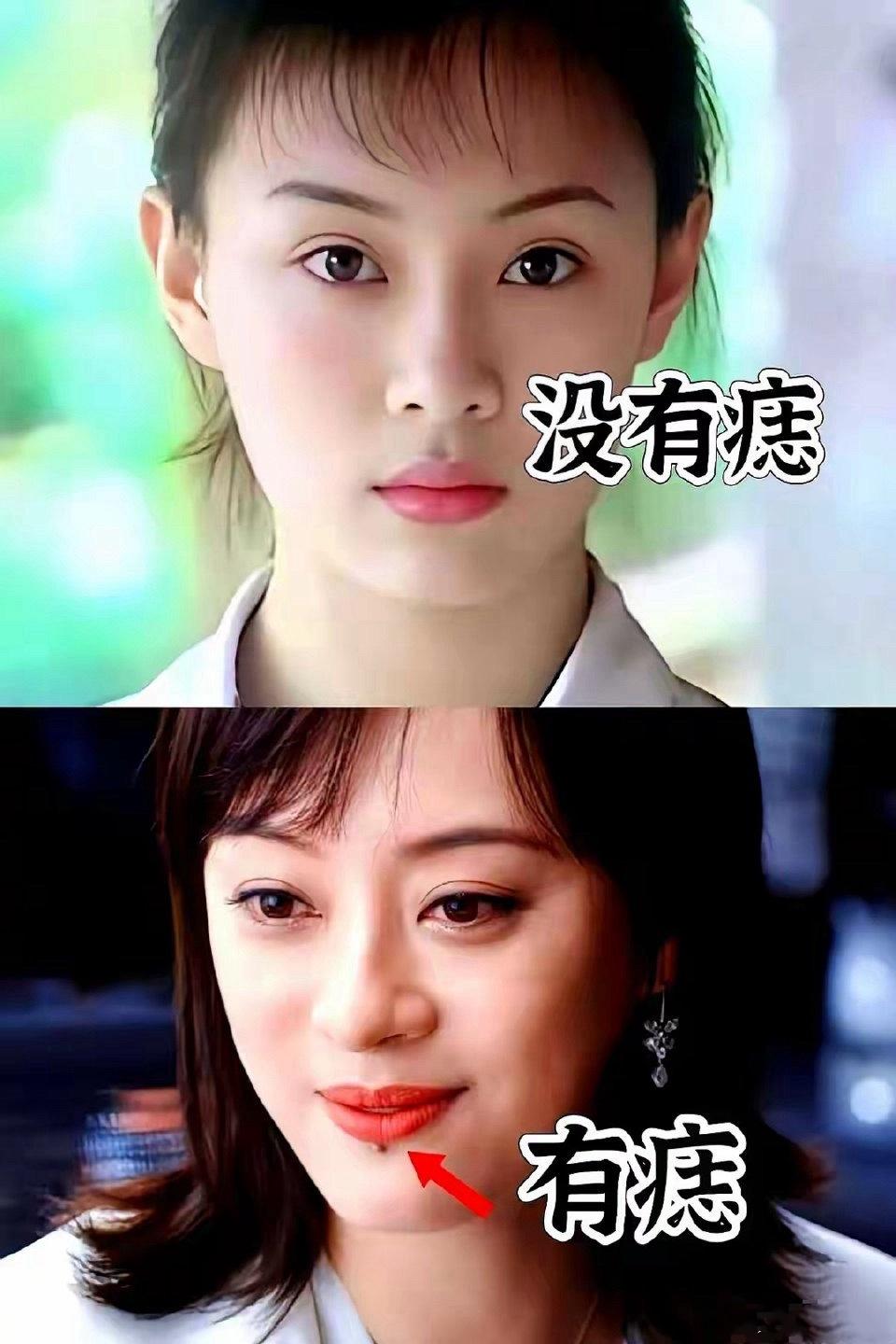原来孙俪嘴角的不是痣，而是车祸受伤的疤！孙俪说：“这玻璃在我体内藏了10年！