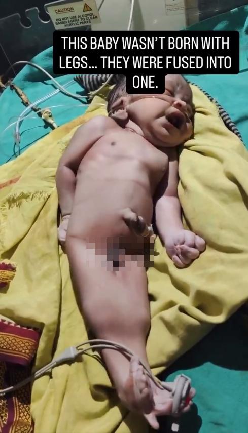一新生儿视频，视频显示其双下肢融合为一体，并连接着医疗设备该患儿需要接受新生儿重