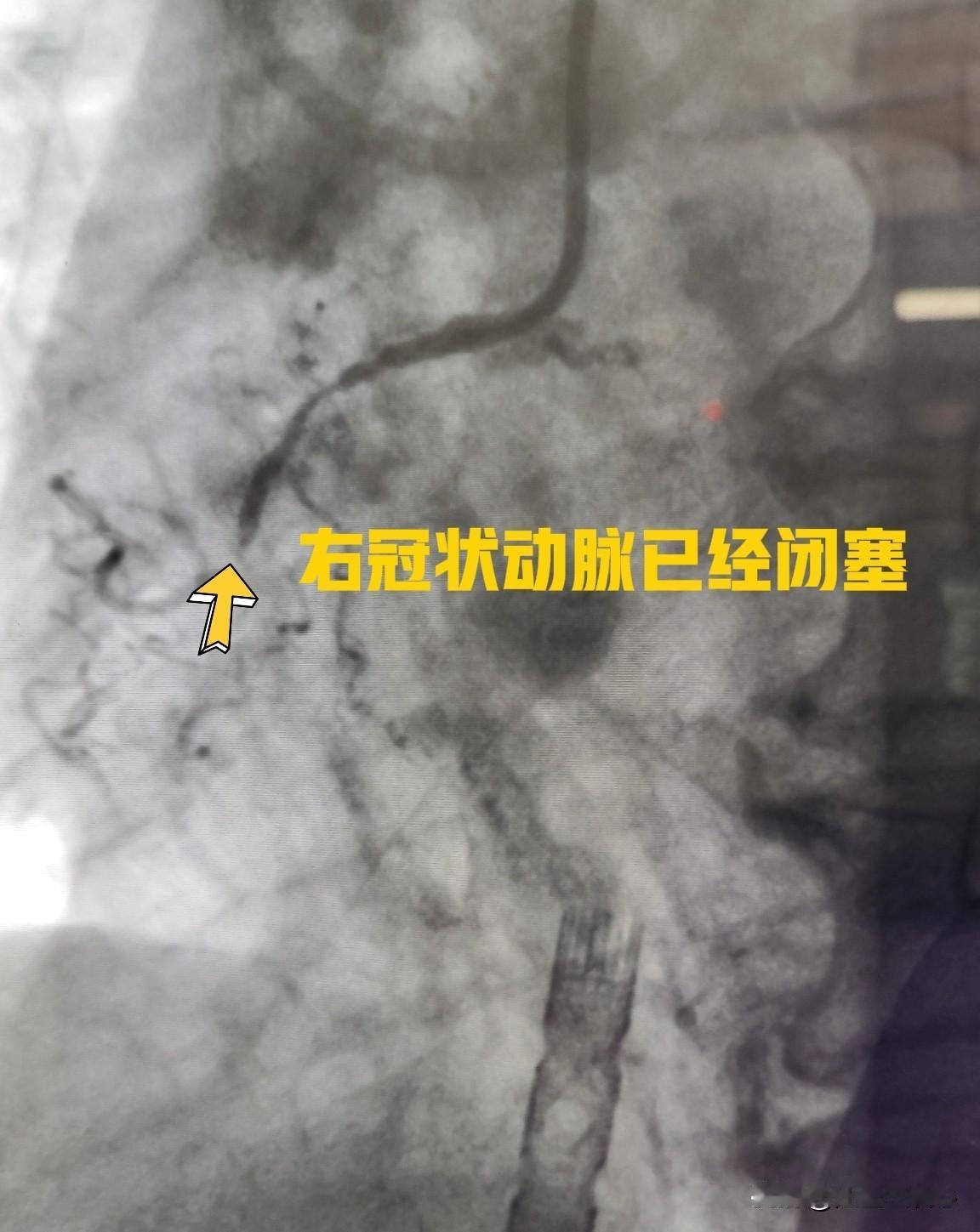 昨天做了一台在ECMO支持下的急诊冠脉支架手术。59岁女性患者，突发胸闷