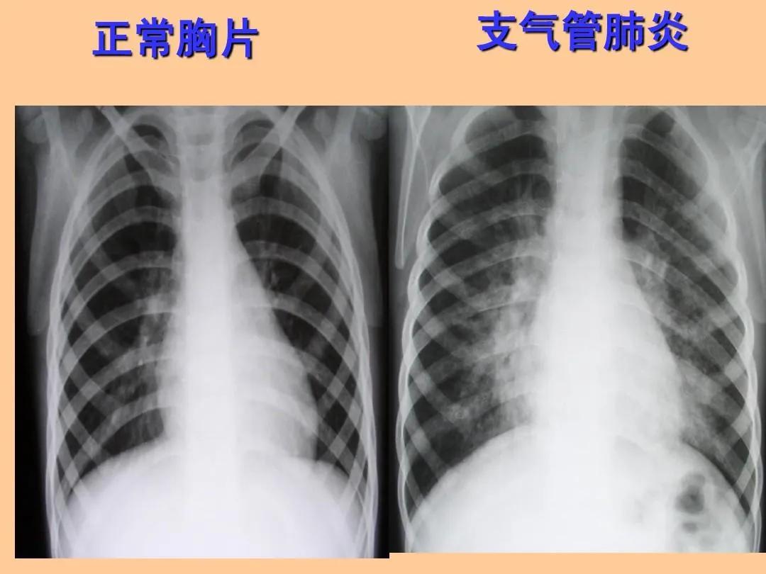 支气管肺炎已经大面积扩散了吗，怎么这么多人得呢？！最近隔壁单位有十几个人因为患