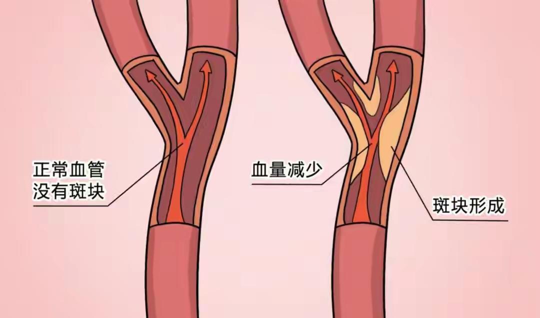 ⏰血栓不是突然到来，患上血栓的人，晚上常常有四个共同点——这不是“睡得晚”，
