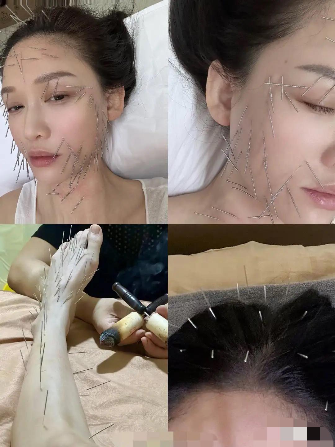 陈乔恩对自己也太狠了吧！我是头一次看到这种针灸，脸上、头顶、腿上扎了有上百根针