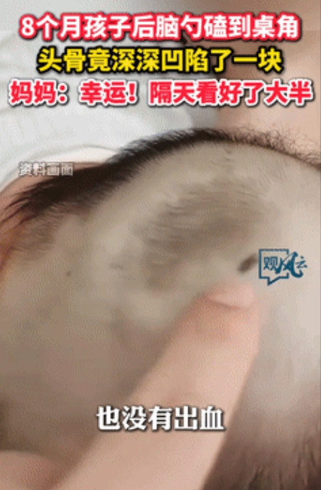 人类幼崽的自愈能力！”8个月婴儿从沙发摔下，后脑勺竟磕出一大凹坑！可万万没想到，