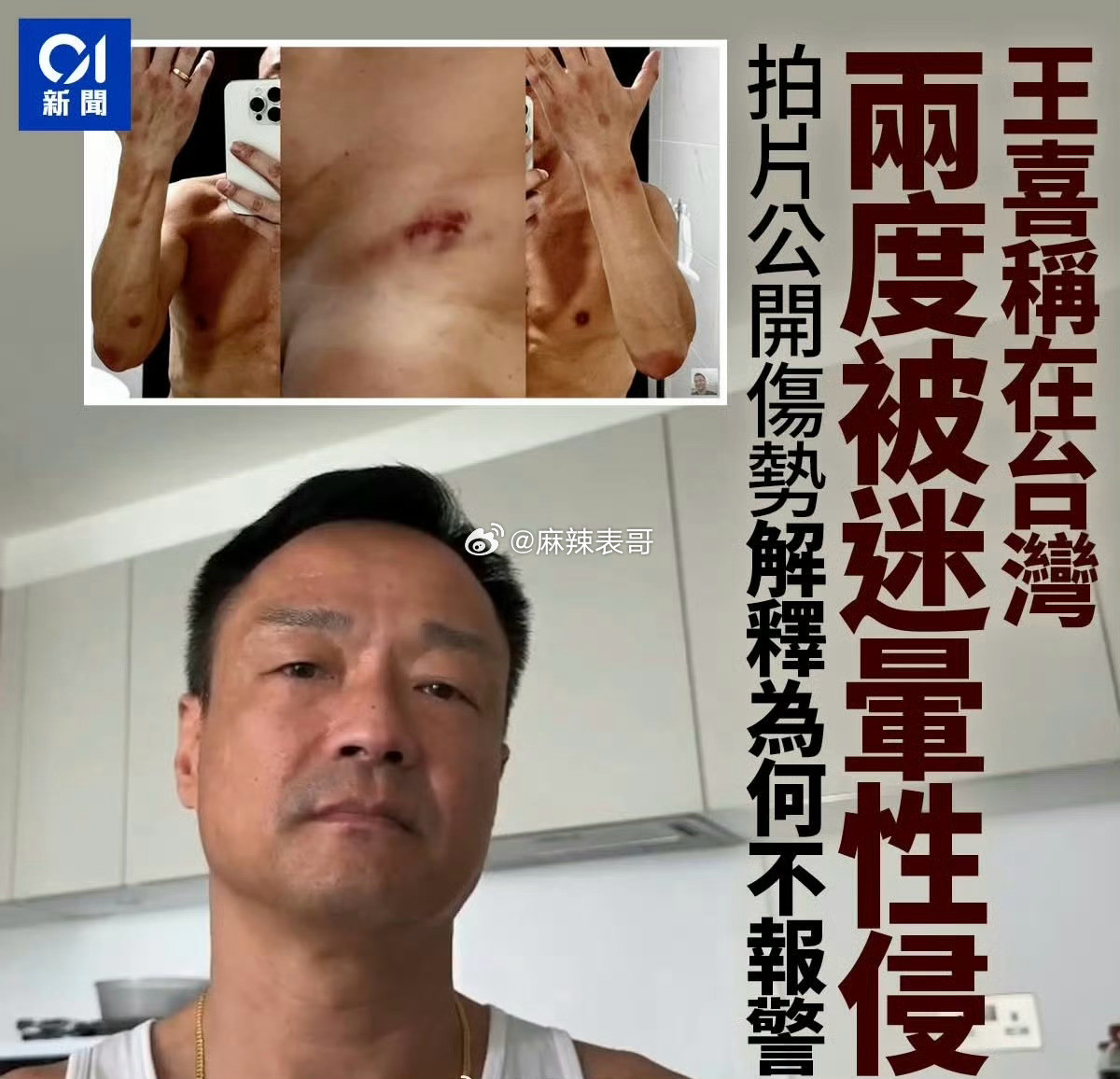王喜自爆肾衰竭了，自己跑医院查，发现原因是自己在朋友家里两次被迷奸，导致横纹肌肉