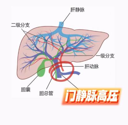 肝硬化患者必看！门静脉高压究竟有多危险！ 对于肝硬化的朋友们而言，“门静脉高