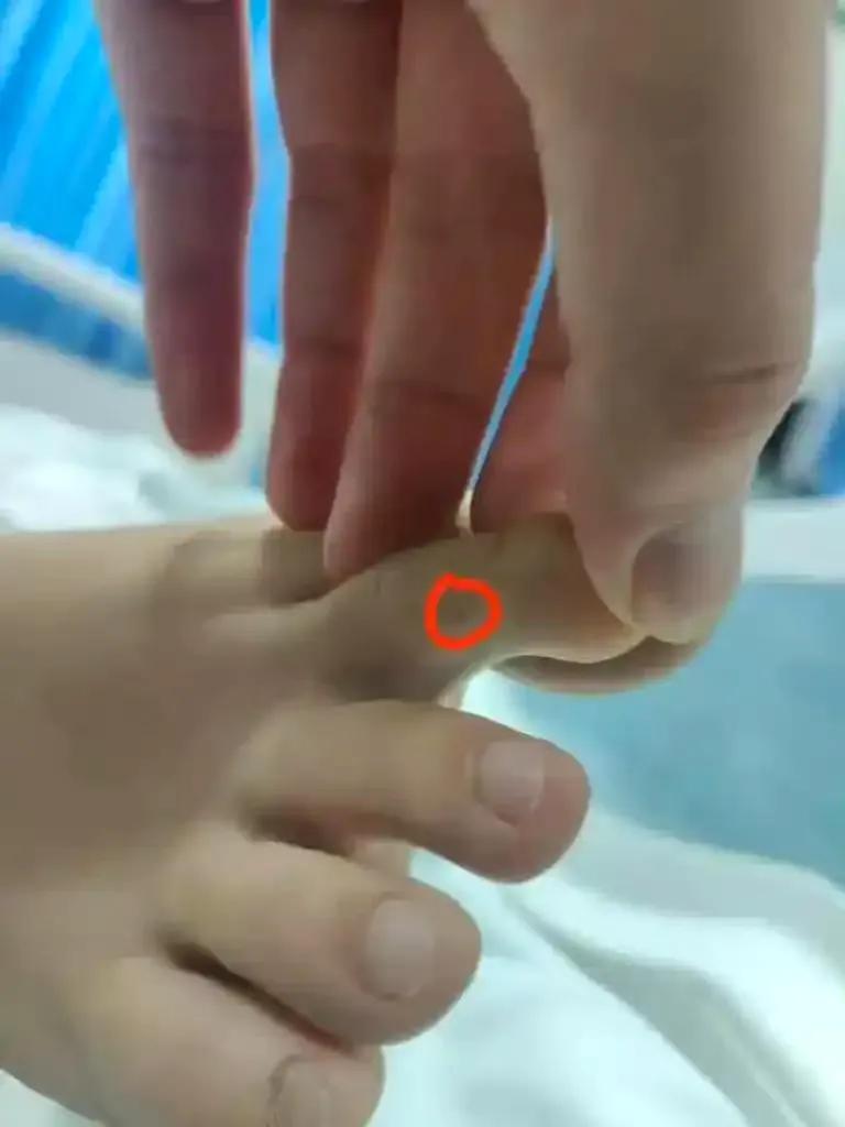 从曝光的来看，第一家医院责任肯定跑不掉，人家到医院第一时间就说了怀疑是蛇咬伤，医