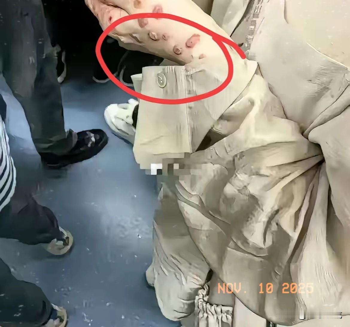地铁上看美女看出一身冷汗？就因为手背红疙瘩，直接脑补成艾滋病，真不是吓唬人，