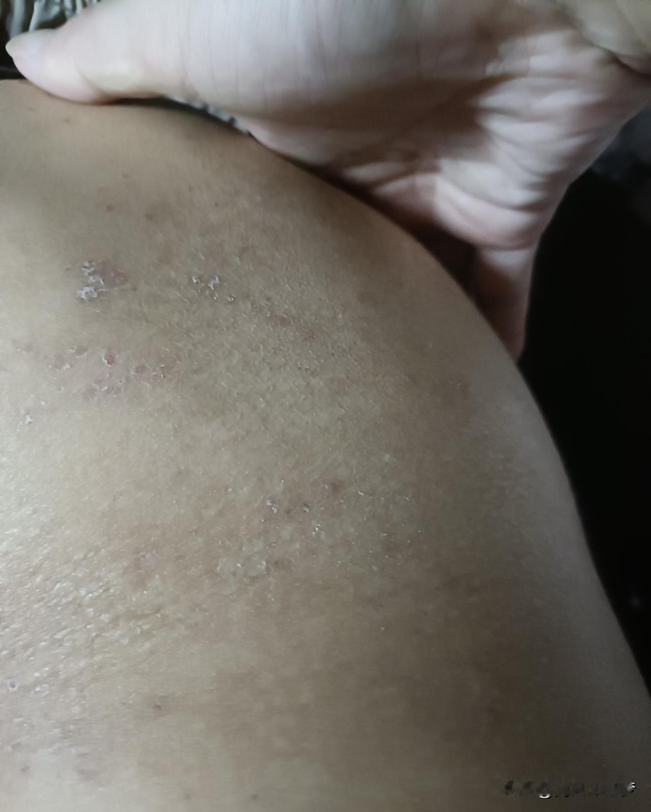 第二周的疱疹擦剩下的药，吃剩下小药丸吃后面开的中药，今天也吃完了。