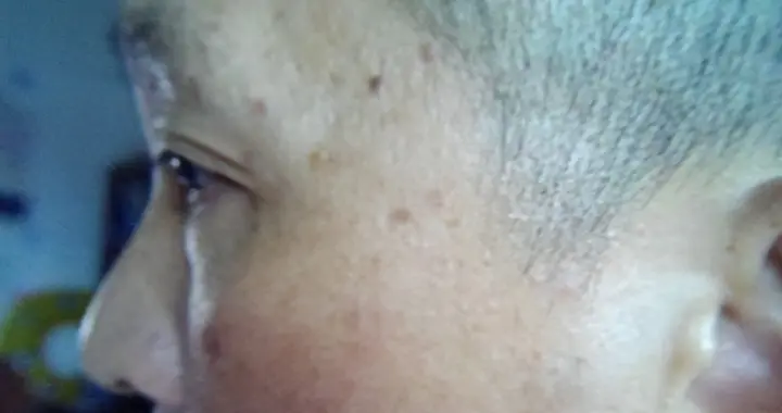 不是皮肤病, 而是癌症预警? 皮肤出现3种异常, 可能是癌症来临
