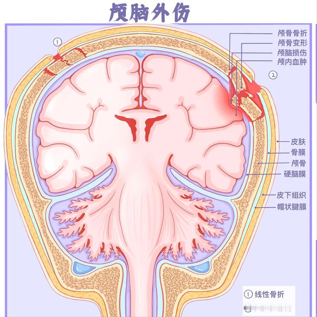 脑外伤和脑出血到底哪个更严重？终于说出大实话！经常有家属着急地问：“医生，是