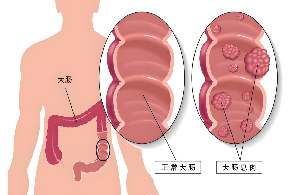 肠息肉，记住6个字，息肉越来越小最近门诊上肠息肉的患者越来越多，很多还都是复发