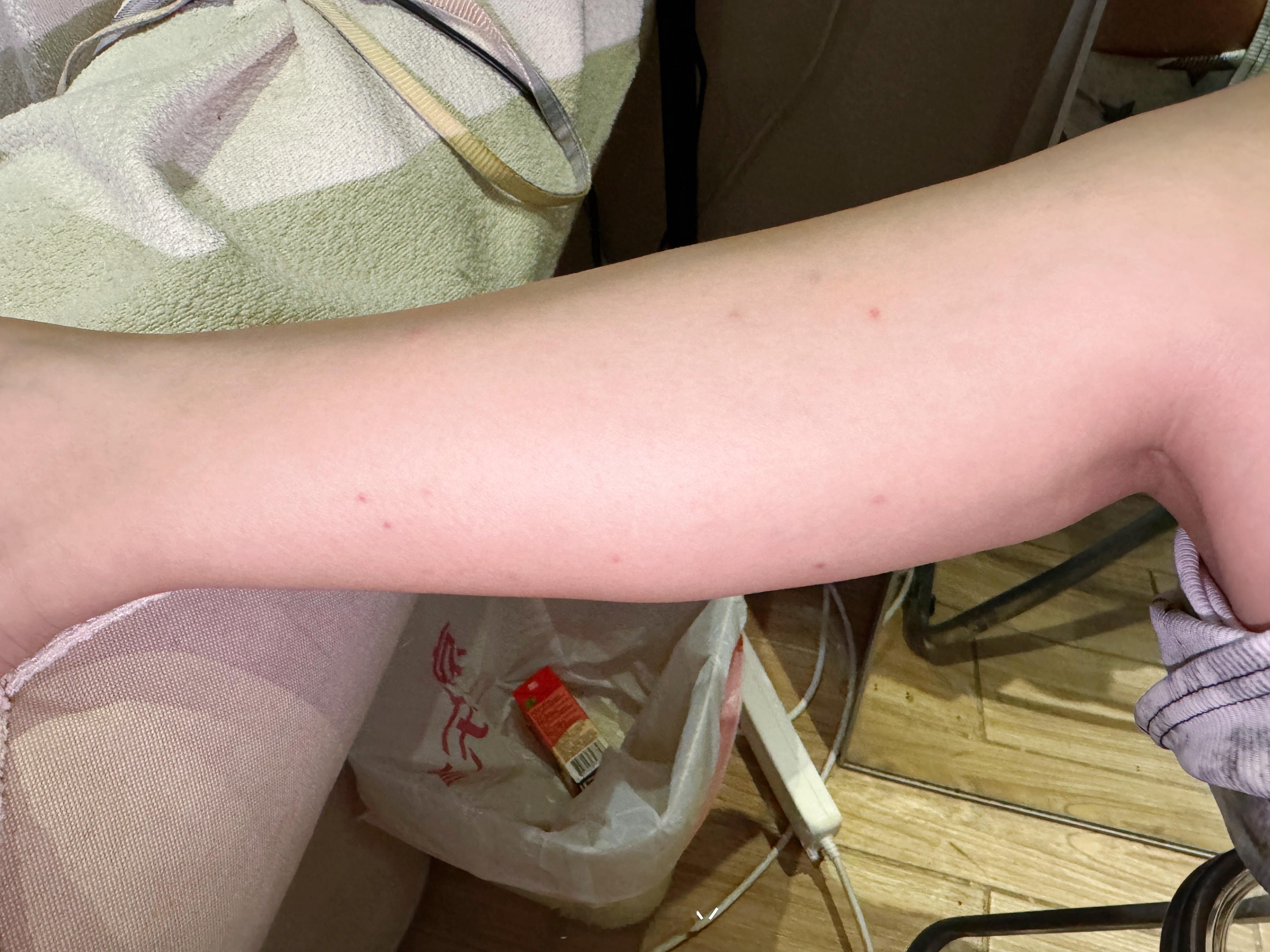 我不行了...前几天拍那个链接天使被毒蚊子咬的包现在都没好，风油精啥的完全没用，
