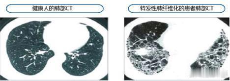 ”肺纤维化”后的预后以及转归：“肺纤维化”是西医病名；中医称为“肺痿”：范氏中医