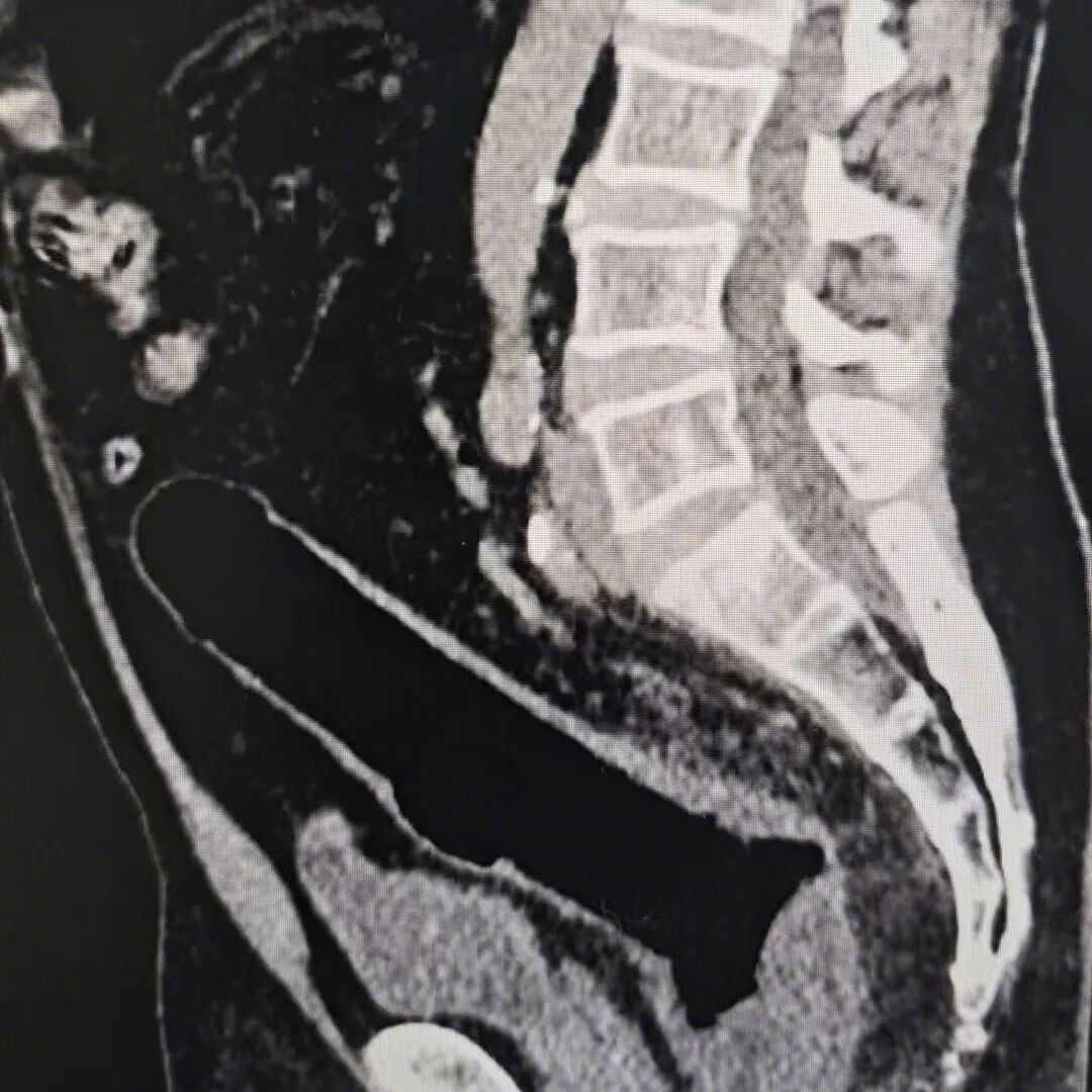#男子肛门进异物忍3天致肠穿孔#【深圳男子“不小心坐到成人物品”，取不出来！强忍