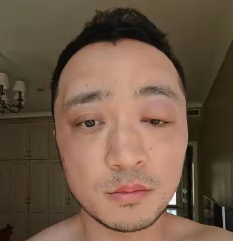 别染发！真不是危言耸听，连明星都扛不住染发剂的伤害。