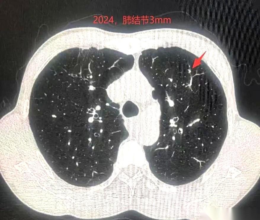 两年。就两年。一个3毫米的小点，在CT片子上几乎都看不清，就这么安安静静地，长