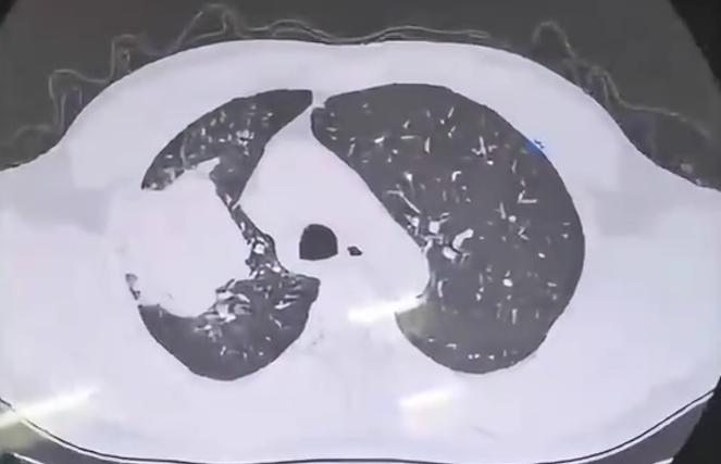 中央型肺鳞癌，绝大多数都与吸烟密切相关！临床上遇到这类患者，我们通常都会询问吸烟