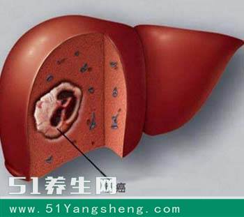 常吃这两种食物易得 肝癌, 肝癌初期会有5个症状!