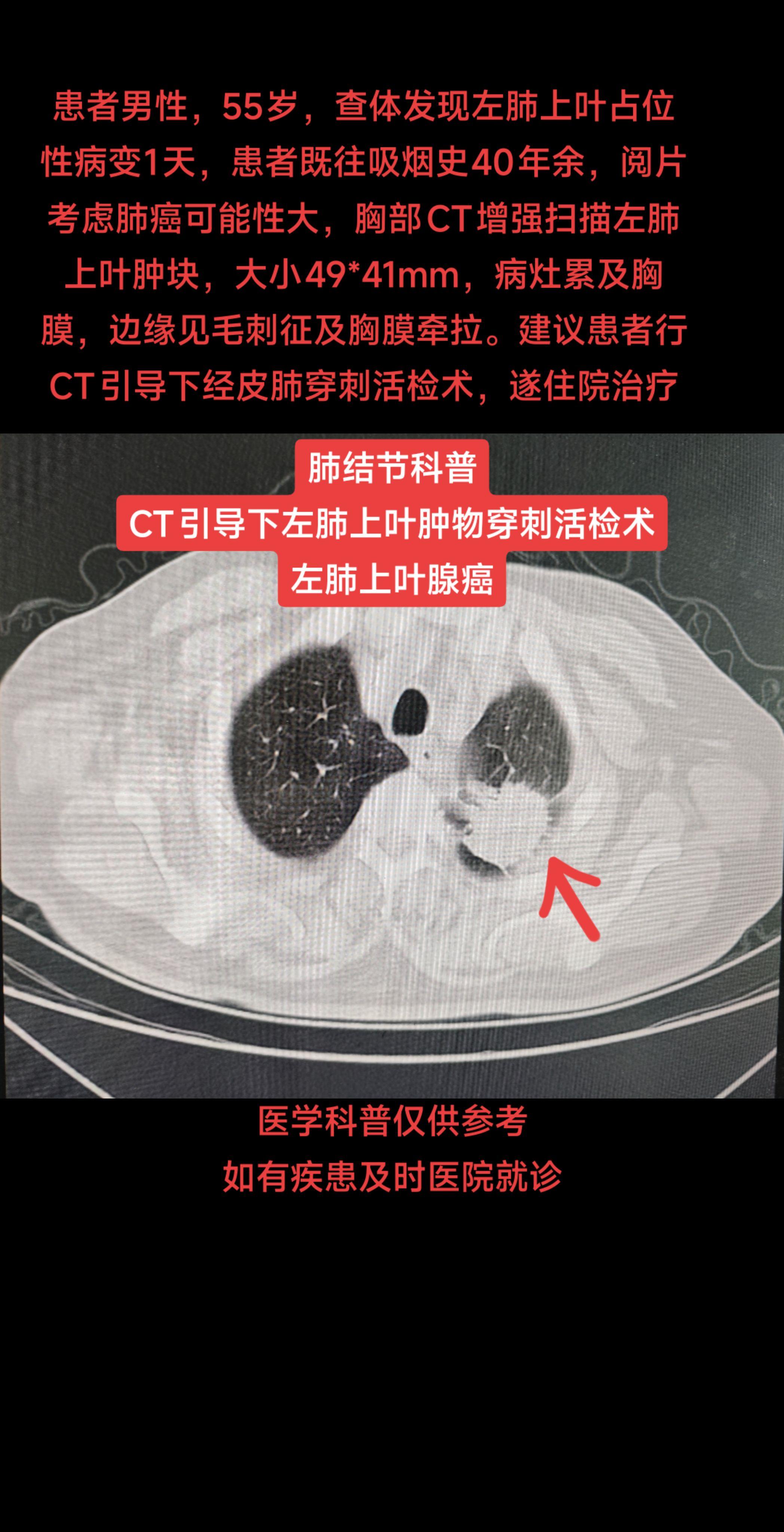 肺结节科普CT引导下经皮肺结节穿刺活检术 患者男性，55岁，查体发现左...