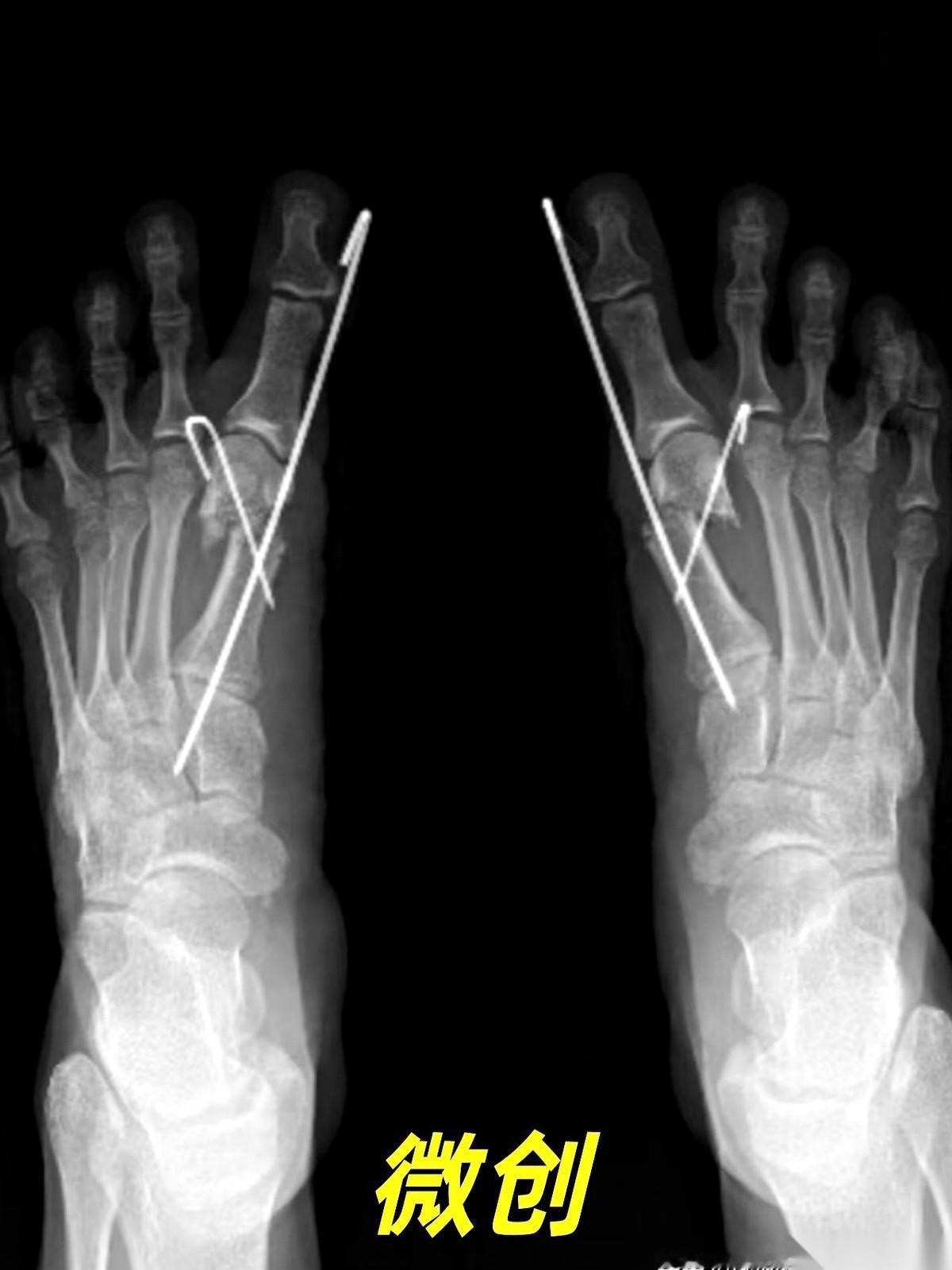 我跟你说，最狠的营销，就是把一个明明需要“伤筋动骨一百天”的事儿，包装成“随做随