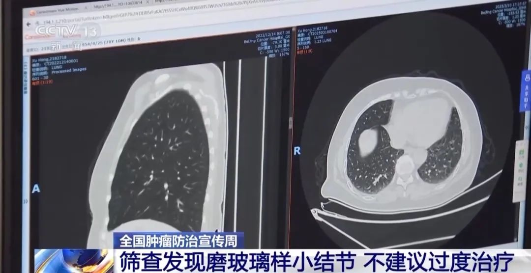 连续10年全球死亡率第一! 记得做这项检查