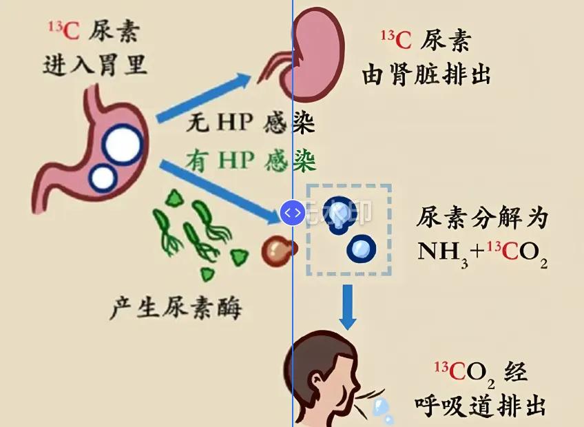 幽门螺杆菌吹气测试方法有C13、C14两种。大家以后一定要选C13别选C14[机