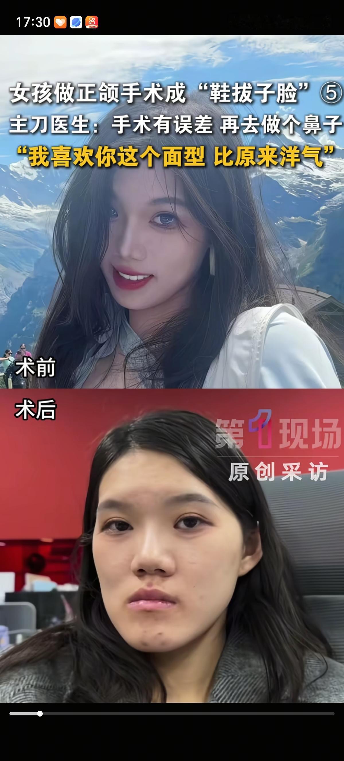 美女模特只是想拔颗牙，结果被推荐去整形正颌了，花8万元把自己整成了“鞋拔子脸”，