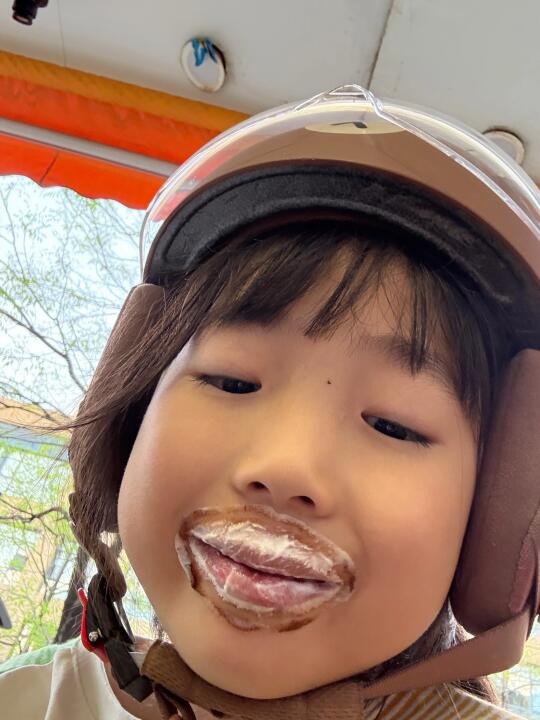 人中缩短术