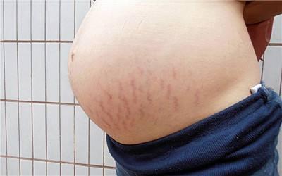 孕期流鼻血还有腹泻, 这些都正常吗?