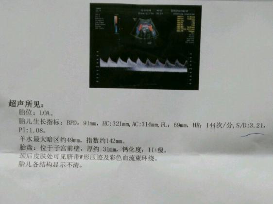 终于卸货了, 附上生娃经历和孕期症状