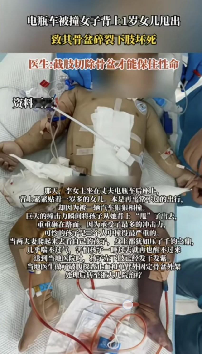 刚看到一个视频，一家三口电瓶车被撞，女子背上1岁女童被甩出去，致其盆骨碎裂下肢坏